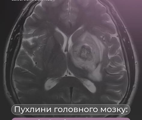 Топ 5 пухлин головного мозку, які найчастіше виявляють на МРТ.